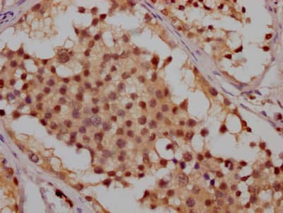 Immunohistochemistry: ATM Antibody (3G11) [NBP3-26494] - Image of ATM Antibody (3G11) diluted at 1:100 and staining in paraffin-embedded human breast cancer performed. After dewaxing and hydration, antigen retrieval was mediated by high pressure in a citrate buffer (pH 6.0). Section was blocked with 10% normal goat serum 30min at RT. Then primary antibody (1% BSA) was incubated at 4C overnight. The primary is detected by a Goat anti-rabbit IgG polymer labeled by HRP and visualized using 0.05% DAB.