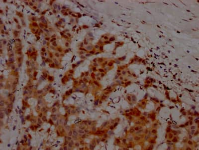 Immunohistochemistry: ATM Antibody (3G11) [NBP3-26494] - Image of ATM Antibody (3G11) diluted at 1:100 and staining in paraffin-embedded human breast cancer performed. After dewaxing and hydration, antigen retrieval was mediated by high pressure in a citrate buffer (pH 6.0). Section was blocked with 10% normal goat serum 30min at RT. Then primary antibody (1% BSA) was incubated at 4C overnight. The primary is detected by a Goat anti-rabbit IgG polymer labeled by HRP and visualized using 0.05% DAB.