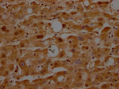 Immunohistochemistry: ATF5 Antibody (9D8) [NBP3-26496] - Image of ATF5 Antibody (9D8) diluted at 1:100 and staining in paraffin-embedded human liver tissue performed. After dewaxing and hydration, antigen retrieval was mediated by high pressure in a citrate buffer (pH 6.0). Section was blocked with 10% normal goat serum 30min at RT. Then primary antibody (1% BSA) was incubated at 4C overnight. The primary is detected by a Goat anti-rabbit IgG polymer labeled by HRP and visualized using 0.05% DAB.