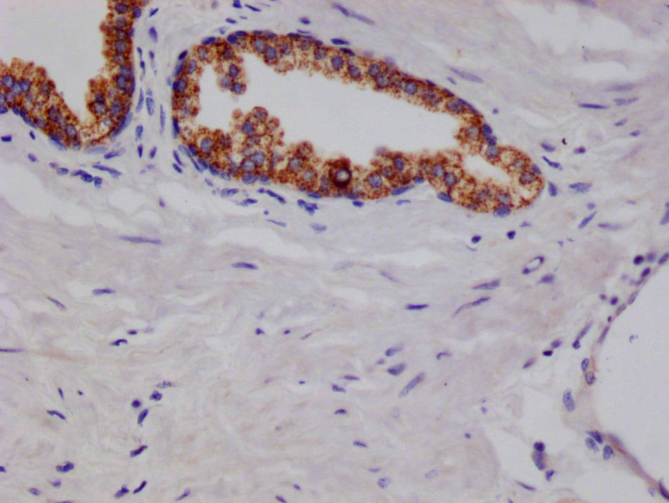 Immunohistochemistry: ARG2 Antibody (9A4) [NBP3-26500] - Image of ARG2 Antibody (9A4) diluted at 1:100 and staining in paraffin-embedded human prostate cancer performed. After dewaxing and hydration, antigen retrieval was mediated by high pressure in a citrate buffer (pH 6.0). Section was blocked with 10% normal goat serum 30min at RT. Then primary antibody (1% BSA) was incubated at 4°C overnight. The primary is detected by a Goat anti-rabbit polymer IgG labeled by HRP and visualized using 0.05% DAB.