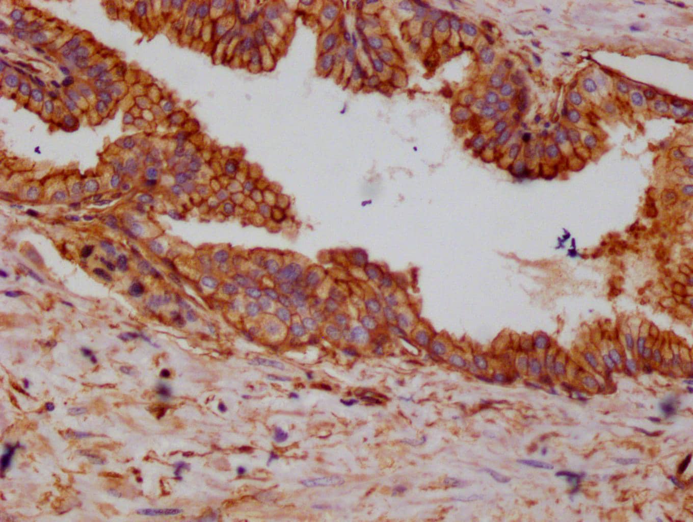 Immunohistochemistry: Annexin A2 Antibody (10H9) [NBP3-26506] - Image of Annexin A2 Antibody (10H9) diluted at 1:100 and staining in paraffin-embedded human prostate cancer performed. After dewaxing and hydration, antigen retrieval was mediated by high pressure in a citrate buffer (pH 6.0). Section was blocked with 10% normal goat serum 30min at RT. Then primary antibody (1% BSA) was incubated at 4°C overnight. The primary is detected by a Goat anti-rabbit polymer IgG labeled by HRP and visualized using 0.05% DAB.