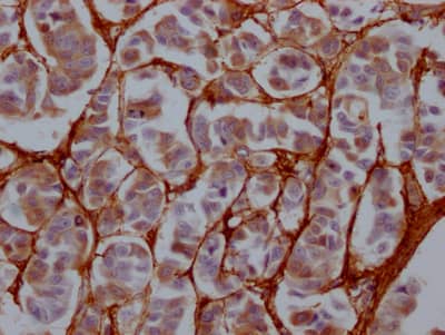 Immunohistochemistry: Fibronectin Antibody (1E1) [NBP3-26577] - Image of Fibronectin Antibody (1E1) diluted at 1:100 and staining in paraffin-embedded human breast cancer performed. After dewaxing and hydration, antigen retrieval was mediated by high pressure in a citrate buffer (pH 6.0). Section was blocked with 10% normal goat serum 30min at RT. Then primary antibody (1% BSA) was incubated at 4C overnight. The primary is detected by a Goat anti-rabbit IgG polymer labeled by HRP and visualized using 0.05% DAB.