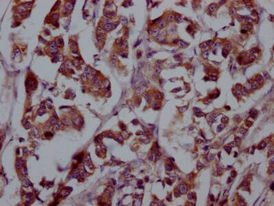 Immunohistochemistry: FGFR4 Antibody (8A5) [NBP3-26580] - Image of FGFR4 Antibody (8A5) diluted at 1:100 and staining in paraffin-embedded human breast cancer performed. After dewaxing and hydration, antigen retrieval was mediated by high pressure in a citrate buffer (pH 6.0). Section was blocked with 10% normal goat serum 30min at RT. Then primary antibody (1% BSA) was incubated at 4C overnight. The primary is detected by a Goat anti-rabbit IgG polymer labeled by HRP and visualized using 0.05% DAB.