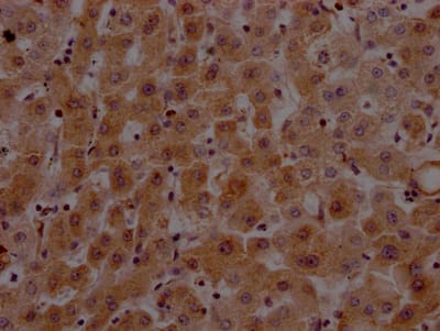 Immunohistochemistry: Prothrombin Antibody (9A1) [NBP3-26594] - Image of Prothrombin Antibody (9A1) diluted at 1:100 and staining in paraffin-embedded human liver tissue performed. After dewaxing and hydration, antigen retrieval was mediated by high pressure in a citrate buffer (pH 6.0). Section was blocked with 10% normal goat serum 30min at RT. Then primary antibody (1% BSA) was incubated at 4C overnight. The primary is detected by a Goat anti-rabbit IgG polymer labeled by HRP and visualized using 0.05% DAB.