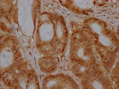 Immunohistochemistry: EZH2/KMT6 Antibody (10H8) [NBP3-26597] - Image of EZH2/KMT6 Antibody (10H8) diluted at 1:100 and staining in paraffin-embedded human colon cancer performed. After dewaxing and hydration, antigen retrieval was mediated by high pressure in a citrate buffer (pH 6.0). Section was blocked with 10% normal goat serum 30min at RT. Then primary antibody (1% BSA) was incubated at 4C overnight. The primary is detected by a Goat anti-rabbit IgG polymer labeled by HRP and visualized using 0.05% DAB.