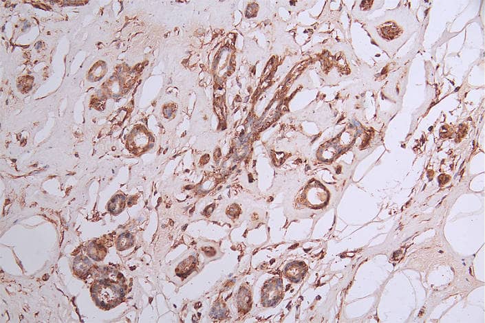 Immunohistochemistry: CRMP2 Antibody (20D8) [NBP3-26612] - Image of CRMP2 Antibody (20D8) diluted at 1:50 and staining in paraffin-embedded human breast cancer performed. After dewaxing and hydration, antigen retrieval was mediated by high pressure in a citrate buffer (pH 6.0). Section was blocked with 10% normal goat serum 30min at RT. Then primary antibody (1% BSA) was incubated at 4°C overnight. The primary is detected by a Goat anti-rabbit polymer IgG labeled by HRP and visualized using 0.35% DAB.