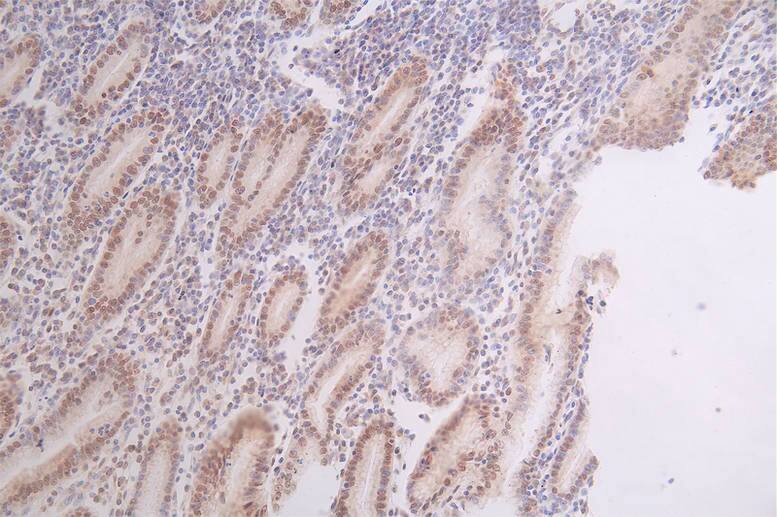 Immunohistochemistry: DEK Antibody (20D2) [NBP3-26624] - Image of DEK Antibody (20D2) diluted at 1:50 and staining in paraffin-embedded human gastric cancer performed. After dewaxing and hydration, antigen retrieval was mediated by high pressure in a citrate buffer (pH 6.0). Section was blocked with 10% normal goat serum 30min at RT. Then primary antibody (1% BSA) was incubated at 4C overnight. The primary is detected by a Goat anti-rabbit polymer IgG labeled by HRP and visualized using 0.67% DAB.