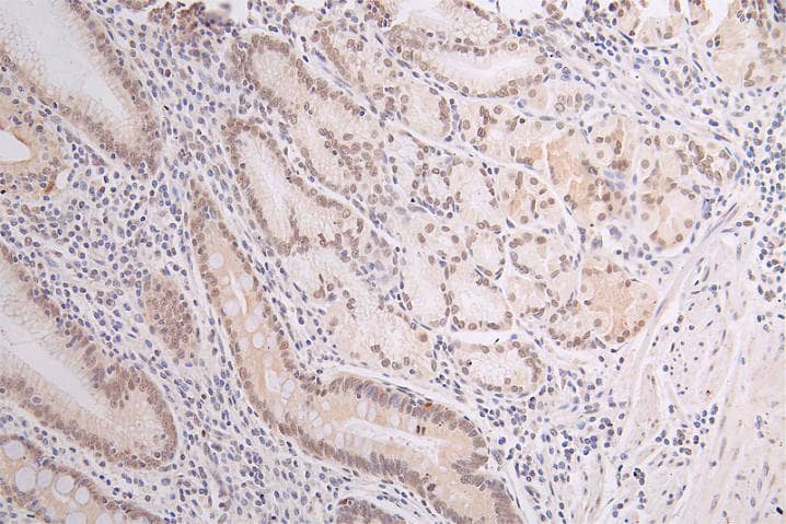 Immunohistochemistry: DEK Antibody (20D2) [NBP3-26624] - Image of DEK Antibody (20D2) diluted at 1:50 and staining in paraffin-embedded human gastric cancer performed. After dewaxing and hydration, antigen retrieval was mediated by high pressure in a citrate buffer (pH 6.0). Section was blocked with 10% normal goat serum 30min at RT. Then primary antibody (1% BSA) was incubated at 4°C overnight. The primary is detected by a Goat anti-rabbit polymer IgG labeled by HRP and visualized using 0.67% DAB.