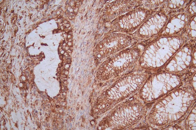Immunohistochemistry: CD44 Antibody (19H12) [NBP3-26680] - Image of CD44 Antibody (19H12) diluted at 1:50 and staining in paraffin-embedded human rectal cancer performed. After dewaxing and hydration, antigen retrieval was mediated by high pressure in a citrate buffer (pH 6.0). Section was blocked with 10% normal goat serum 30min at RT. Then primary antibody (1% BSA) was incubated at 4C overnight. The primary is detected by a Goat anti-rabbit polymer IgG labeled by HRP and visualized using 0.51% DAB.