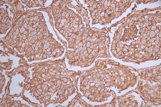 Immunohistochemistry: CD44 Antibody (19H12) [NBP3-26680] - Image of CD44 Antibody (19H12) diluted at 1:50 and staining in paraffin-embedded human rectal cancer performed. After dewaxing and hydration, antigen retrieval was mediated by high pressure in a citrate buffer (pH 6.0). Section was blocked with 10% normal goat serum 30min at RT. Then primary antibody (1% BSA) was incubated at 4C overnight. The primary is detected by a Goat anti-rabbit polymer IgG labeled by HRP and visualized using 0.51% DAB.