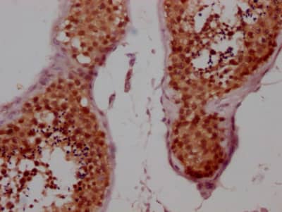 Immunohistochemistry: Cyclin E1 Antibody (3A5) [NBP3-26692] - Image of Cyclin E1 Antibody (3A5) diluted at 1:100 and staining in paraffin-embedded human breast cancer performed. After dewaxing and hydration, antigen retrieval was mediated by high pressure in a citrate buffer (pH 6.0). Section was blocked with 10% normal goat serum 30min at RT. Then primary antibody (1% BSA) was incubated at 4C overnight. The primary is detected by a Goat anti-rabbit IgG polymer labeled by HRP and visualized using 0.05% DAB.