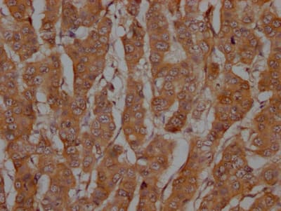 Immunohistochemistry: Caspase-3 Antibody (5B2) - Pro [NBP3-26699] - Image of Caspase-3 Antibody (5B2) - Pro diluted at 1:100 and staining in paraffin-embedded human breast cancer performed. After dewaxing and hydration, antigen retrieval was mediated by high pressure in a citrate buffer (pH 6.0). Section was blocked with 10% normal goat serum 30min at RT. Then primary antibody (1% BSA) was incubated at 4C overnight. The primary is detected by a Goat anti-rabbit IgG polymer labeled by HRP and visualized using 0.05% DAB.