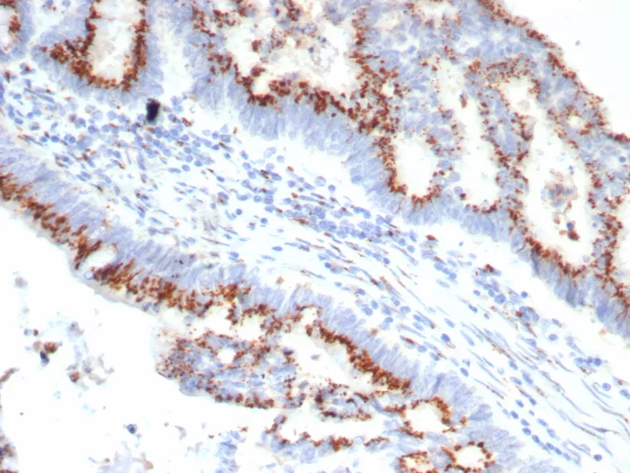 Formalin-fixed, paraffin-embedded human colon carcinoma stained with OVOL2 Antibody (OVOL2/6776). HIER: Tris/EDTA, pH9.0, 45min. 2°C: HRP-polymer, 30min. DAB, 5min.