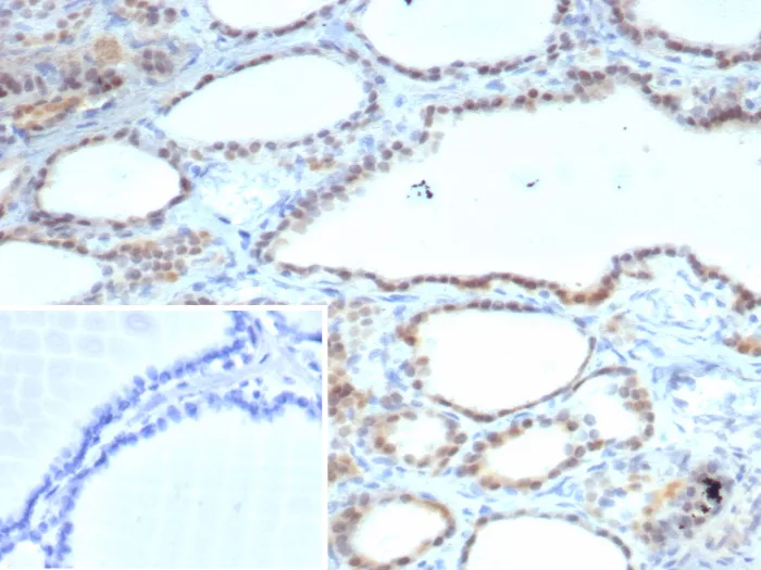 Formalin-fixed, paraffin-embedded human thyroid stained with S100A13 Antibody (S100A13/7484). Inset: PBS instead of primary antibody; secondary only negative control.