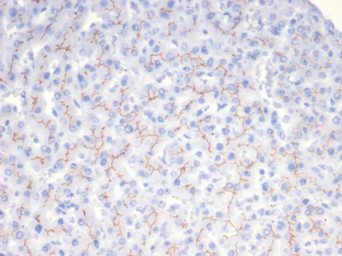 Formalin-fixed, paraffin-embedded human liver stained with ABCB11 Antibody (BSEP/7534). HIER: Tris/EDTA, pH9.0, 45min. 2°C: HRP-polymer, 30min. DAB, 5min.