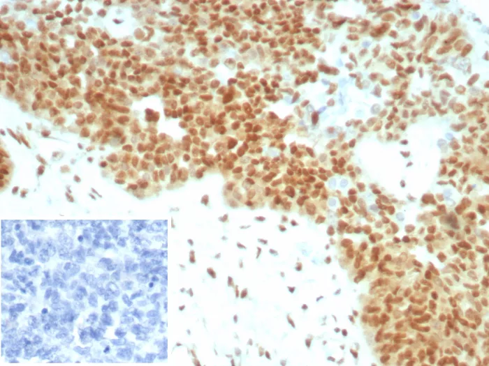 Formalin-fixed, paraffin-embedded human ovarian cancer stained with E2F-4 Antibody (E2F4/8931R). HIER: Tris/EDTA, pH9.0, 45min. 2°C: HRP-polymer, 30min. DAB, 5min.