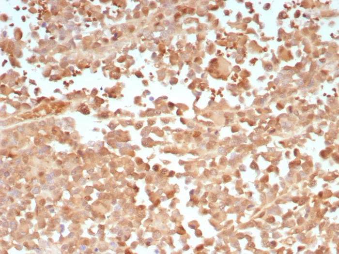 Formalin-fixed, paraffin-embedded human melanoma stained with PRAME Antibody (PRAME/9188). HIER: Tris/EDTA, pH9.0, 45min. 2°C: HRP-polymer, 30min. DAB, 5min.