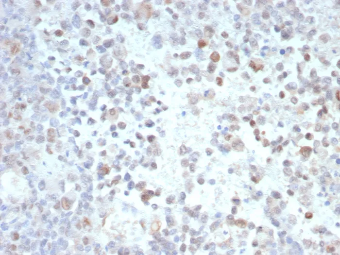 Formalin-fixed, paraffin-embedded human melanoma stained with PRAME Antibody (PRAME/9189). HIER: Tris/EDTA, pH9.0, 45min. 2°C: HRP-polymer, 30min. DAB, 5min.