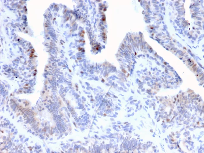 Formalin-fixed, paraffin-embedded human prostate cancer stained with LRH-1/NR5A2 Antibody (PCRP-NR5A2-1B8). HIER: Tris/EDTA, pH9.0, 45min. 2°C: HRP-polymer, 30min. DAB, 5min.