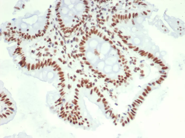 Formalin-fixed, paraffin-embedded human colon carcinoma stained with HDGF Antibody (PCRP-HDGF-1D1). HIER: Tris/EDTA, pH9.0, 45min. 2°C: HRP-polymer, 30min. DAB, 5min.