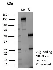 Formalin-fixed, paraffin-embedded human hepatocellular carcinoma stained with Aldo-keto Reductase 1C1/AKR1C1 Antibody (AKR1C1/9070) - Azide and BSA Free. HIER: Tris/EDTA, pH9.0, 45min. 2°C: HRP-polymer, 30min. DAB, 5min.