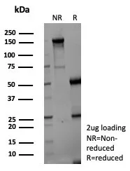 Formalin-fixed, paraffin-embedded human hepatocellular carcinoma stained with Aldo-keto Reductase 1C1/AKR1C1 Antibody (AKR1C1/9069) - Azide and BSA Free. HIER: Tris/EDTA, pH9.0, 45min. 2°C: HRP-polymer, 30min. DAB, 5min.