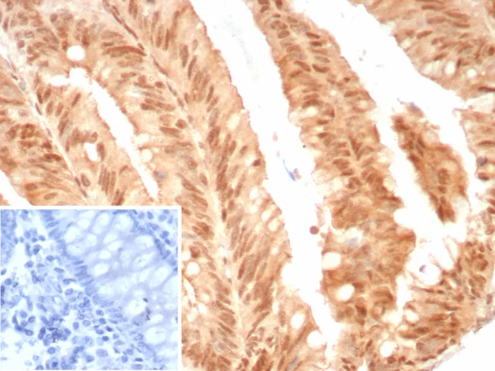 Formalin-fixed, paraffin-embedded human colon cancer stained with E2F-4 Antibody (E2F4/8811R) - Azide and BSA Free. HIER: Tris/EDTA, pH9.0, 45min. 2°C: HRP-polymer, 30min. DAB, 5min.