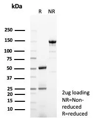 Formalin-fixed, paraffin-embedded human liver in HCC stained with GCHFR Antibody (GCHFR/7731) - Azide and BSA Free. HIER: Tris/EDTA, pH9.0, 45min. 2°C: HRP-polymer, 30min. DAB, 5min.