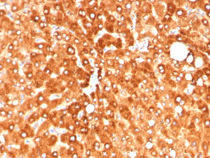 Formalin-fixed, paraffin-embedded human hepatocellular carcinoma stained with Haptoglobin Antibody (HP/4813) - Azide and BSA Free. HIER: Tris/EDTA, pH9.0, 45min. 2°C: HRP-polymer, 30min. DAB, 5min.