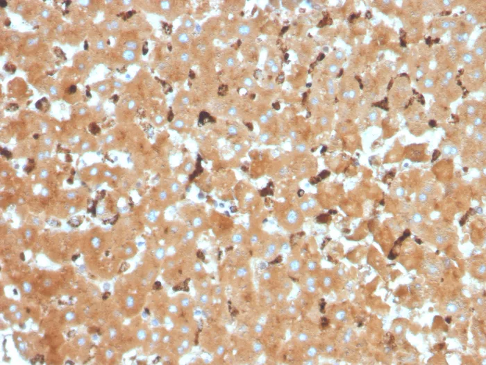 Formalin-fixed, paraffin-embedded human liver carcinoma in colon stained with Haptoglobin Antibody (HP/3832) - Azide and BSA Free. HIER: Tris/EDTA, pH9.0, 45min. 2°C: HRP-polymer, 30min. DAB, 5min.