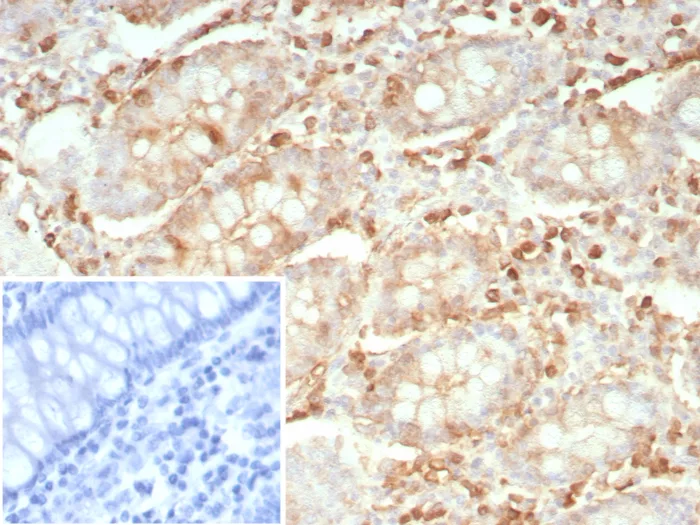 Formalin-fixed, paraffin-embedded human colon carcinoma stained with Stathmin 1 Antibody (rSTMN1/9255) - Azide and BSA Free. Inset: PBS instead of primary antibody; secondary only negative control.