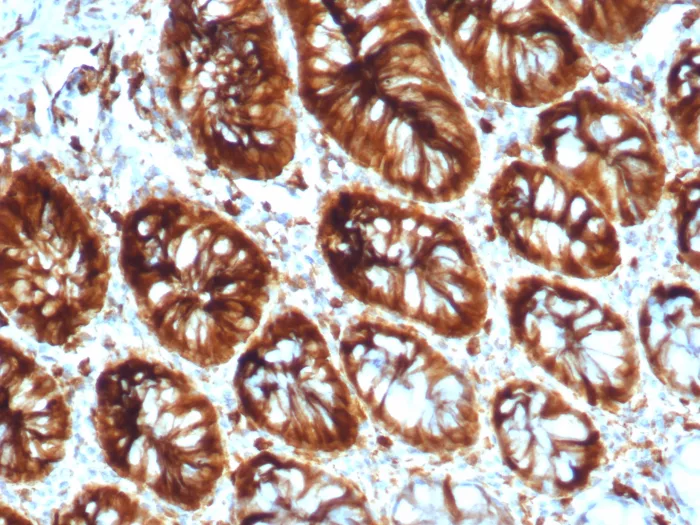 Formalin-fixed, paraffin-embedded human colon stained with Stathmin 1 Antibody (STMN1/8012) - Azide and BSA Free. HIER: Tris/EDTA, pH9.0, 45min. 2°C: HRP-polymer, 30min. DAB, 5min.