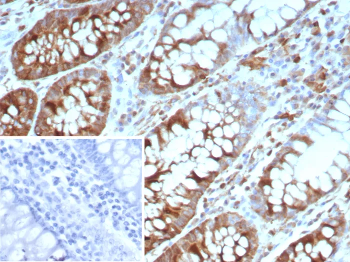 Formalin-fixed, paraffin-embedded human colon carcinoma stained with Stathmin 1 Antibody (STMN1/8437) - Azide and BSA Free. Inset: PBS instead of primary antibody; secondary only negative control.