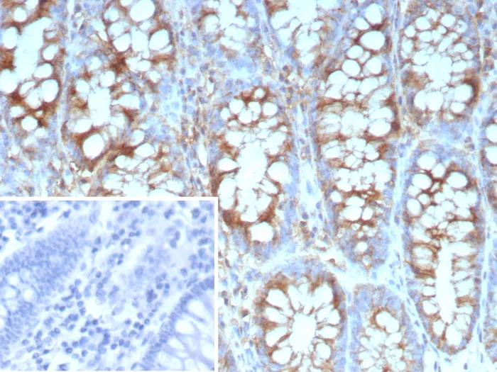 Formalin-fixed, paraffin-embedded human colon carcinoma stained with Stathmin 1 Antibody (STMN1/9227R) - Azide and BSA Free. Inset: PBS instead of primary antibody; secondary only negative control.