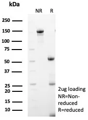 IHC analysis of formalin-fixed, paraffin-embedded human ovarian cancer. MxA/Mx1 Antibody (MX1/7527) - Azide and BSA Free. Inset: PBS instead of primary antibody; secondary only negative control.