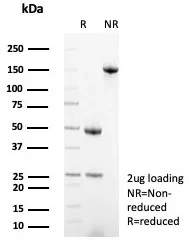 IHC analysis of formalin-fixed, paraffin-embedded human ovarian cancer. MxA/Mx1 Antibody (MX1/7530) - Azide and BSA Free. Inset: PBS instead of primary antibody; secondary only negative control.