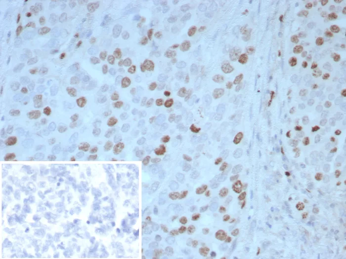Formalin-fixed, paraffin-embedded human ovarian carcinoma stained with Pax4 Antibody (PAX4/7598) - Azide and BSA Free. Inset: PBS instead of primary antibody; secondary only negative control.