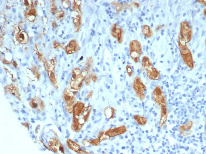 Formalin-fixed, paraffin-embedded human lung stained with Serpin B5/Maspin Antibody (SERPINB5/4971) - Azide and BSA Free. HIER: Tris/EDTA, pH9.0, 45min. 2°C: HRP-polymer, 30min. DAB, 5min.