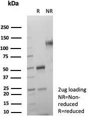 Formalin-fixed, paraffin-embedded human colon carcinoma stained with SDHA Antibody (SDHA/7491) - Azide and BSA Free. HIER: Tris/EDTA, pH9.0, 45min. 2°C: HRP-polymer, 30min. DAB, 5min.