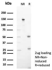 Formalin-fixed, paraffin-embedded human kidney cancer stained with Tryptophan Hydroxylase 1/TPH-1 Antibody (TPH1/7662) - Azide and BSA Free. HIER: Tris/EDTA, pH9.0, 45min. 2°C: HRP-polymer, 30min. DAB, 5min.
