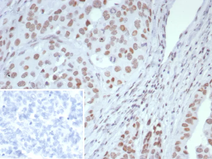 Formalin-fixed, paraffin-embedded human ovarian cancer stained with ARID1A Antibody (ARID1A/7735) - Azide and BSA Free. Inset: PBS instead of primary antibody; secondary only negative control.