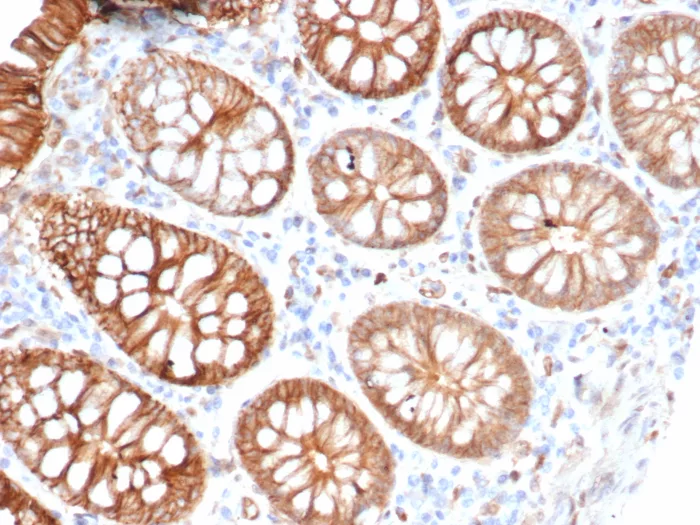 Formalin-fixed, paraffin-embedded human colon carcinoma stained with S100A16 Antibody (S100A16/7411) - Azide and BSA Free. HIER: Tris/EDTA, pH9.0, 45min. 2°C: HRP-polymer, 30min. DAB, 5min.