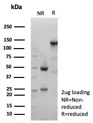 Formalin-fixed, paraffin-embedded human triple negative breast cancer stained with xCT Antibody (SLC7A11/9136R) - Azide and BSA Free.  Inset: PBS instead of primary antibody; secondary only negative control.