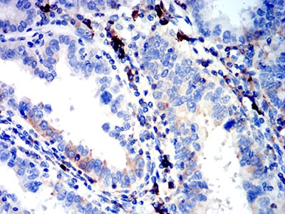 Immunohistochemistry: Ig Lambda C Domain/IGLC2 Antibody (5E12B9) [NBP3-27124] - Analysis of paraffin-embedded endometrial cancer tissues using Ig Lambda C Domain/IGLC2 mouse mAb with DAB staining.