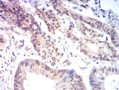 Immunohistochemistry: HBO1 Antibody (1D9H9) [NBP3-27148] - Analysis of paraffin-embedded colon cancer tissues using HBO1 mouse mAb with DAB staining.