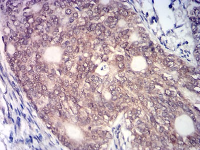 Immunohistochemistry: HBO1 Antibody (1D9H9) [NBP3-27148] - Analysis of paraffin-embedded cervical cancer tissues using HBO1 mouse mAb with DAB staining.