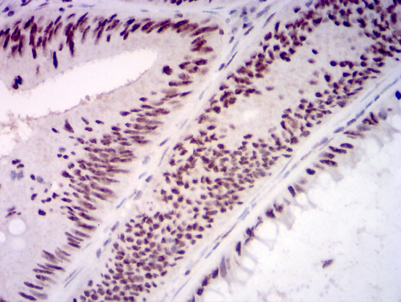 Immunohistochemistry: KMT2D Antibody (1D10F6) [NBP3-27156] - Analysis of paraffin-embedded rectum cancer tissues using KMT2D mouse mAb with DAB staining.