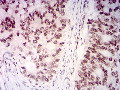 Immunohistochemistry: KMT2D Antibody (1D10F6) [NBP3-27156] - Analysis of paraffin-embedded cervical cancer tissues using KMT2D mouse mAb with DAB staining.