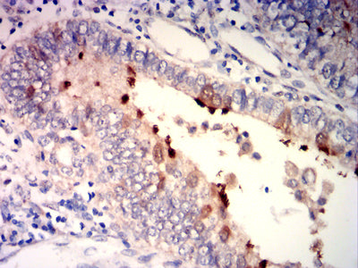 Immunohistochemistry: SP17 Antibody (1C4C7) [NBP3-27162] - Analysis of paraffin-embedded endometrial cancer tissues using SP17 mouse mAb with DAB staining.
