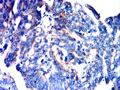 Immunohistochemistry: FPRL2/FPR3 Antibody (8A6G12) [NBP3-27172] - Analysis of paraffin-embedded rectum cancer tissues using FPRL2/FPR3 mouse mAb with DAB staining.